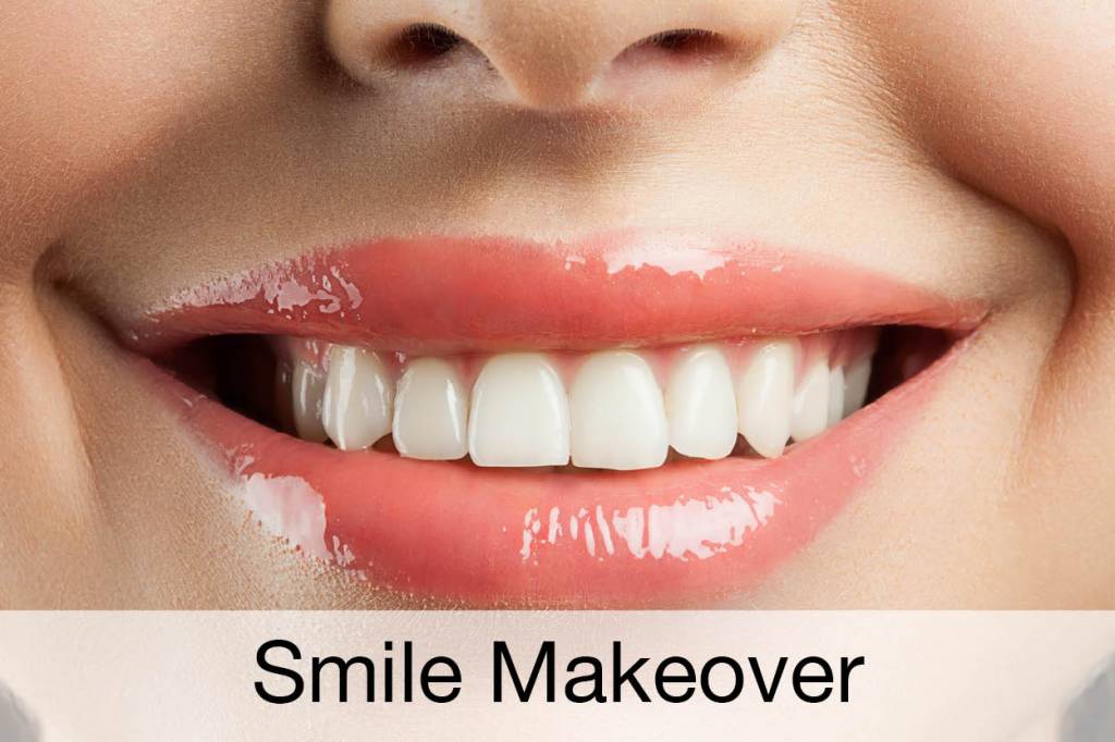 smile makeover