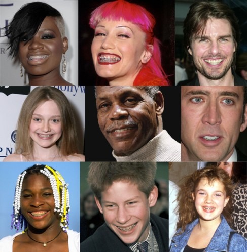 Celebrities with braces