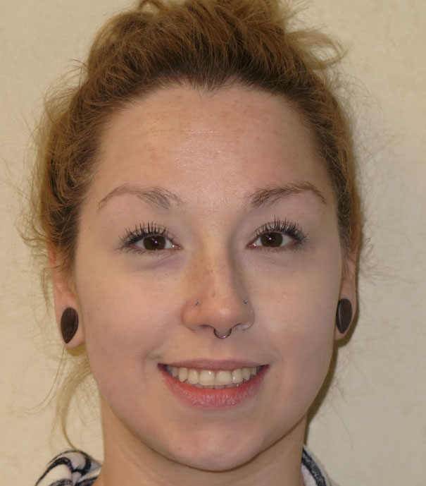LY15-FinalSmile-1 Vermette Orthodontics