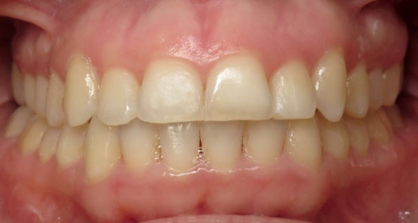 LY15-Finalantocclusal3-2 Vermette Orthodontics