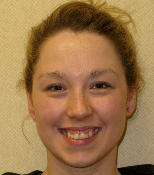 LY15-Initial-Exam-smile-1 Vermette Orthodontics