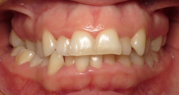 LY15-Initial-Examantocclusal-1 Vermette Orthodontics